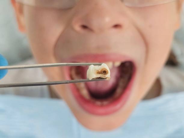 Best Emergency Dentist for Lost Fillings or Crowns in Orange City, FL